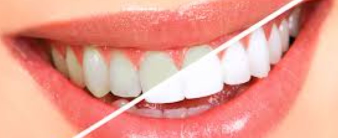 Unlocking the Secrets of Dazzling Smiles: Your Ultimate Guide to Teeth Whitening